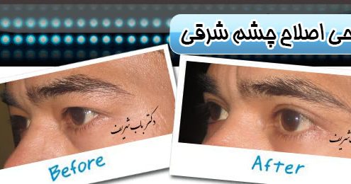 جراحی اصلاح چشم شرقی